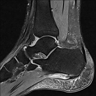 足踝矢狀面磁振造影(MRI)影像