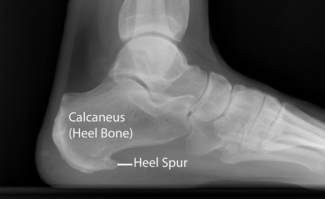 足部側面 X 光影像,標示跟骨(Calcaneus)與跟骨骨刺(Heel Spur)