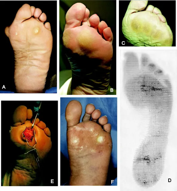 臨床照片集（A–F）：前足胼胝等足底病灶、足壓圖與手術所見