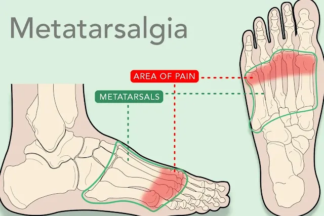 蹠骨痛（Metatarsalgia）示意圖：足側面與俯視圖，標示蹠骨與前足疼痛區